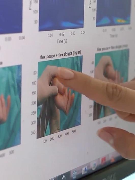 Preparation de la pose d'implants chirurgicaux pour restaurer la préhension chez des personnes tetraplégiques (projet Agilis)